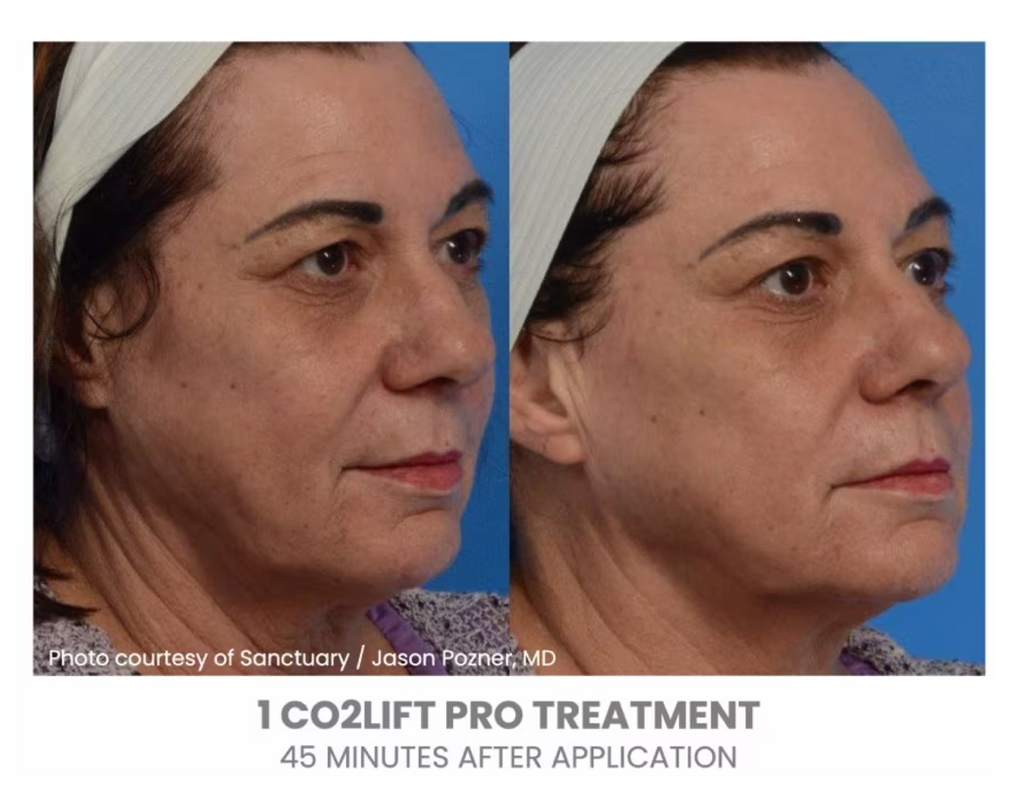 CO2 Lift Pro Box of 3