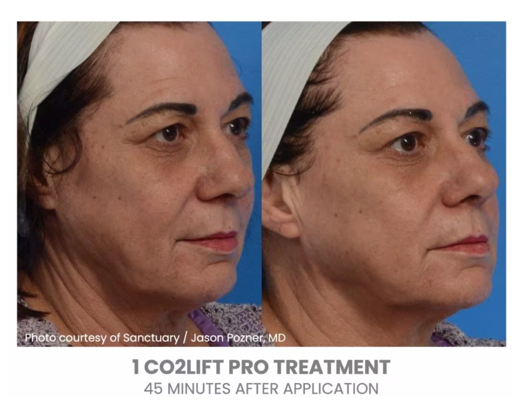 CO2 Lift Pro Box of 3