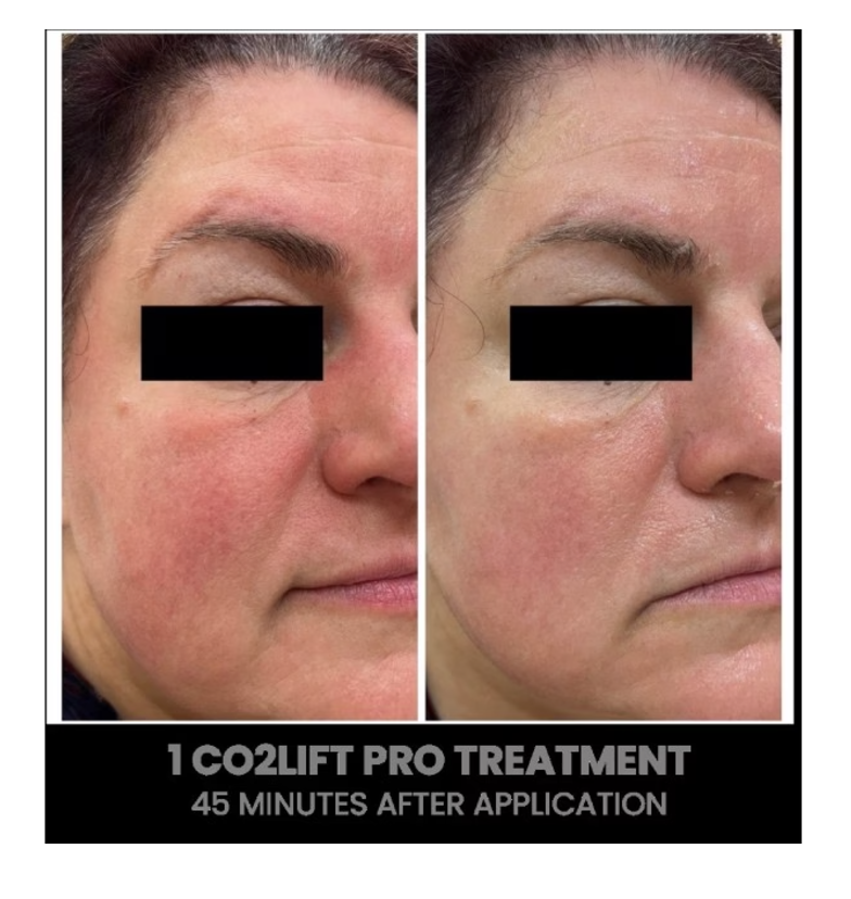 CO2 Lift Pro Box of 3