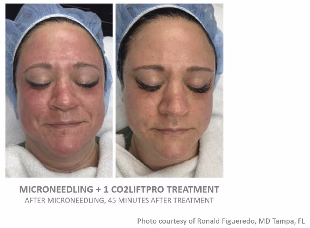 CO2 Lift Pro Box of 3